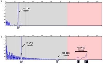 Prenatal Diagnosis of Fragile X: Can a Full Mutation Allele in the FMR1 Gene Contract to a Normal Size?